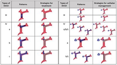 Insights Into Endovascular Management of Superior Vena Cava Obstructions